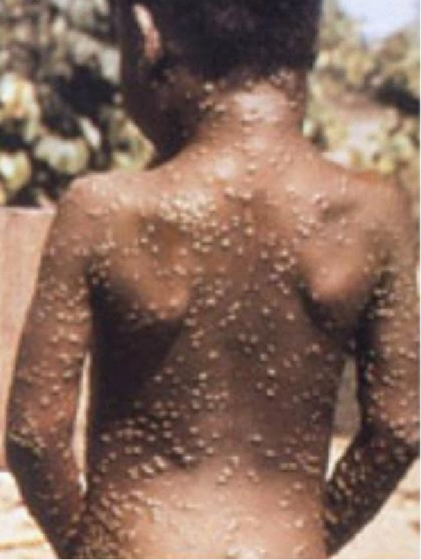 Clinical-picture-of-Monkeypox-rash-Image-credit-CDC-https-wwwcdcgov-poxvirus_W640